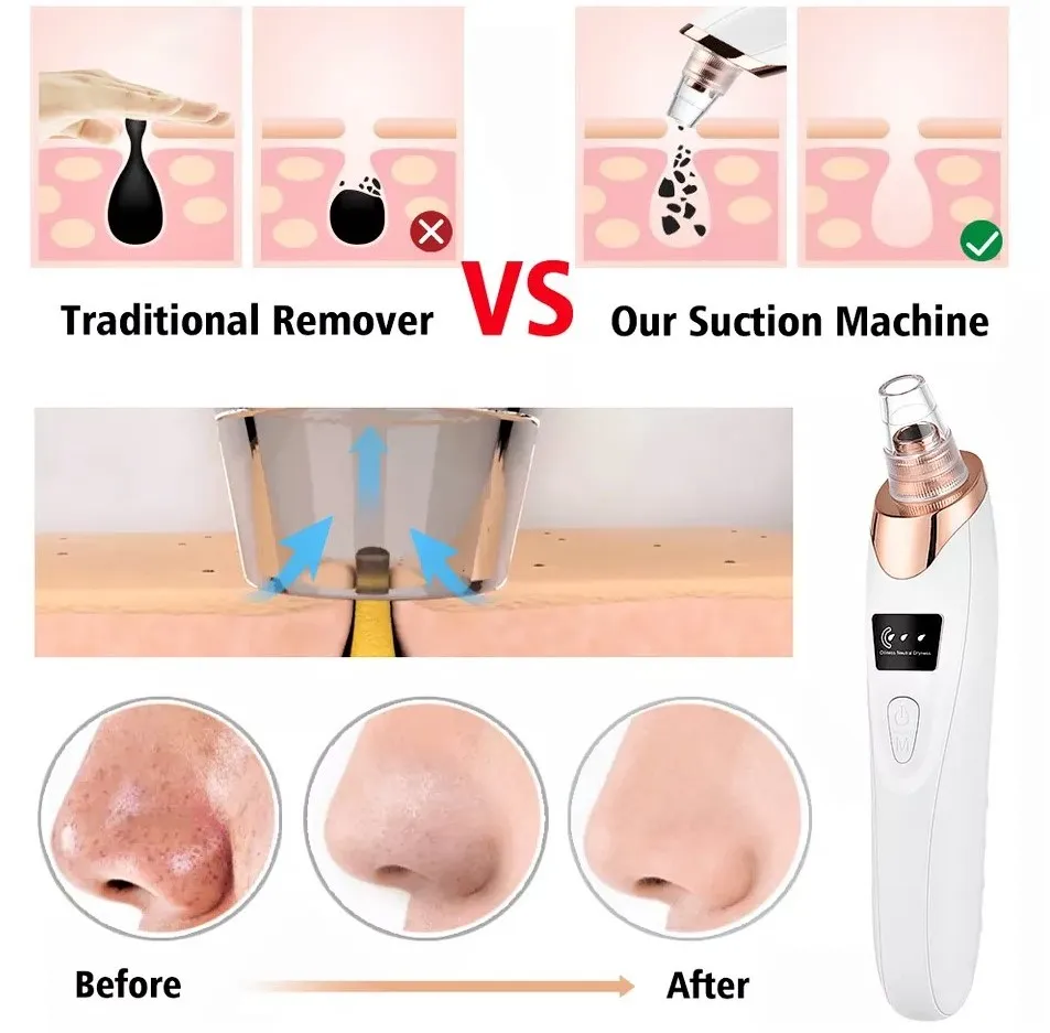 5-in-1 Rechargeable Blackhead Vacuum | Pore Cleaner with 5 Heads